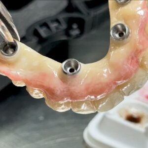 Prótesis Dental Fija Personalizada